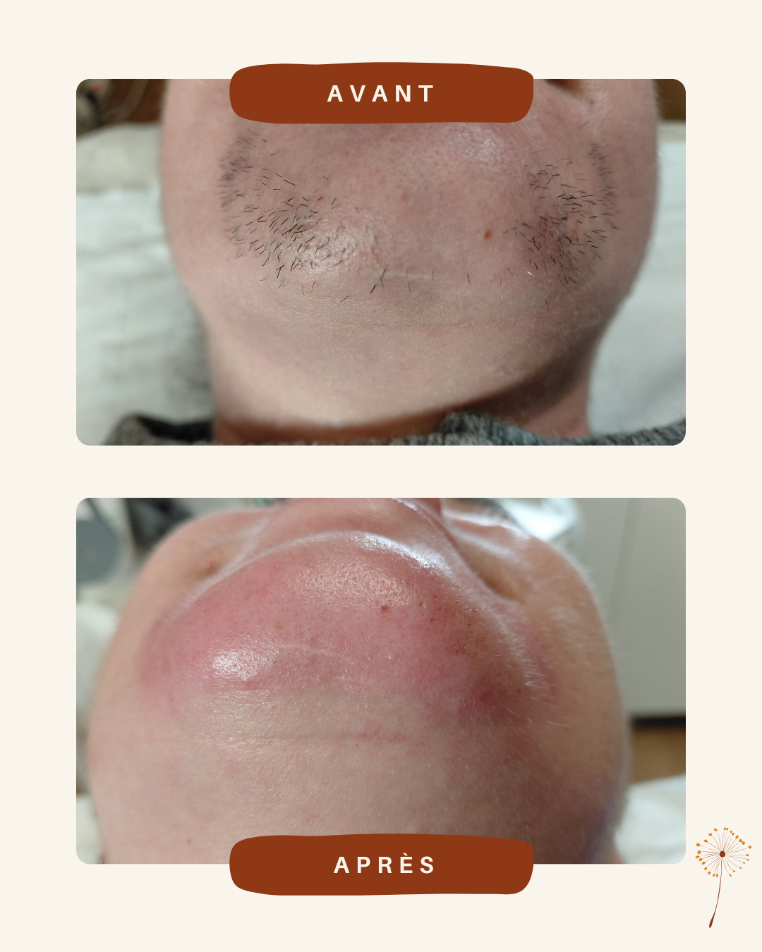 avant/après épilation définitive par thermolyse chez Maison Epyle